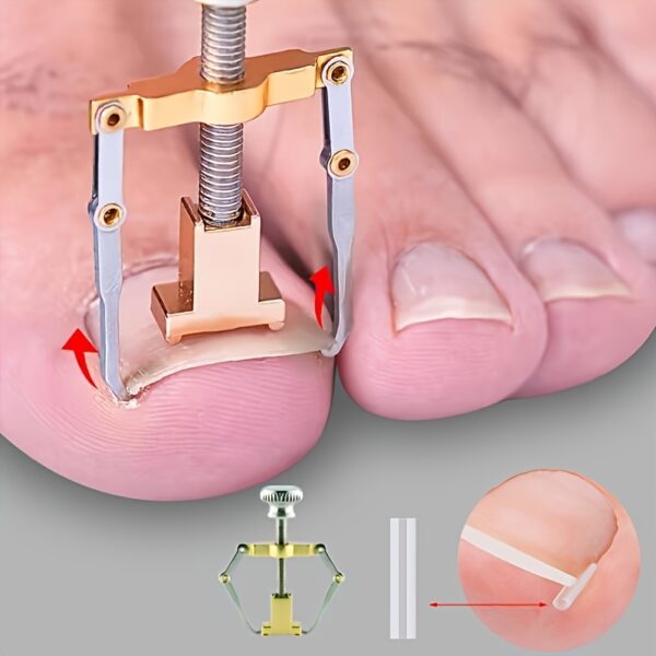 51pcs embedded toenail kit including aids and separators, with a soft-touch ingrown nail adjuster tool designed for gentle trimming, softening, and treating foot nails, equipped with odorless nail files for foot care and hygiene